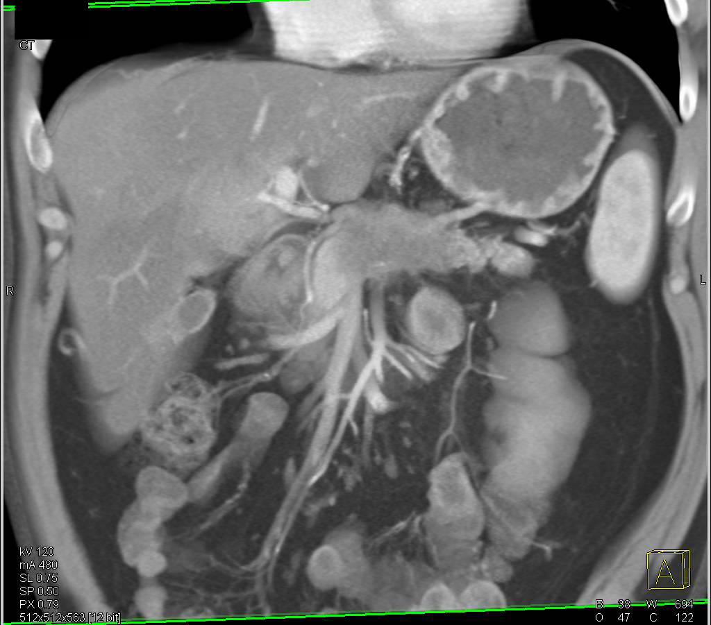 Carcinoma of the Body of the Pancreas with Celiac Encasement - CTisus CT Scan