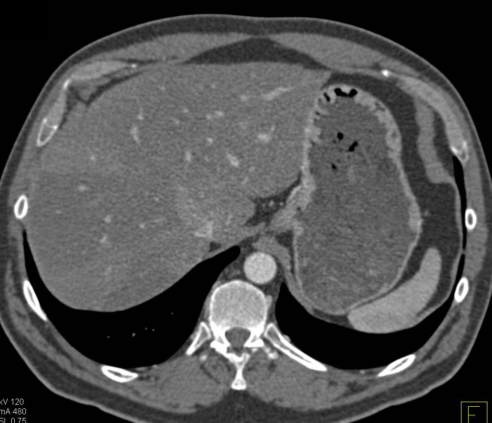 Pancreatic Adenocarcinoma with Vascular Invasion - CTisus CT Scan