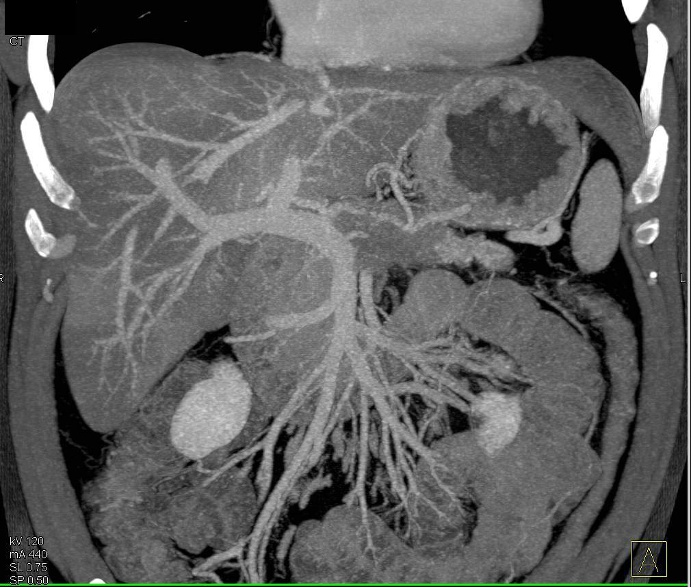 Pancreatic Adenocarcinoma Occludes the Splenic Vein - CTisus CT Scan