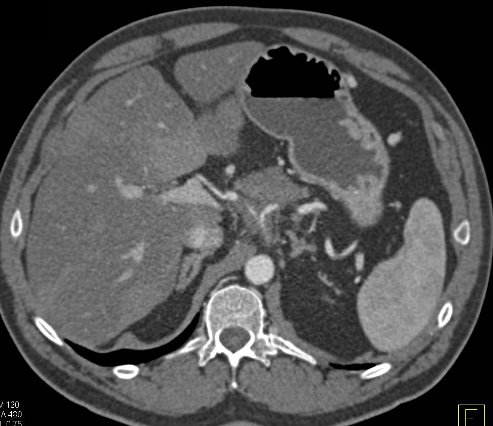 Pancreatic Adenocarcinoma Encases the Celiac and Hepatic Artery - CTisus CT Scan