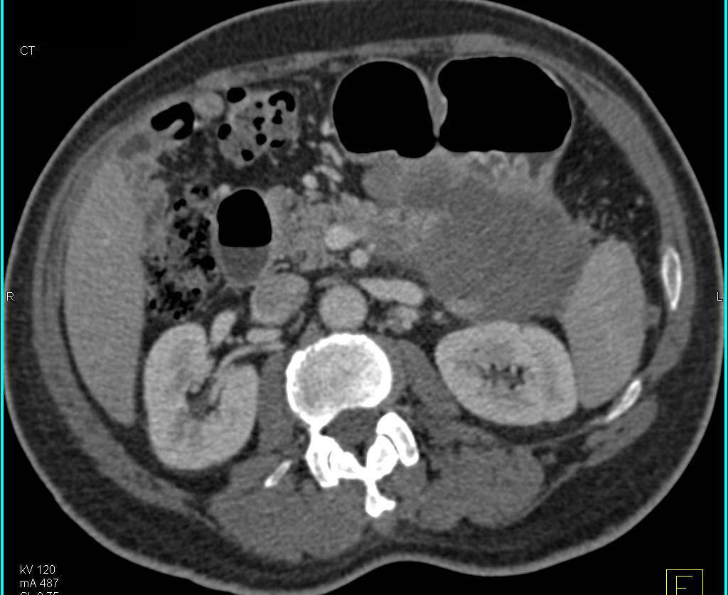 Infiltrating Carcinoma of the Tail of Pancreas - CTisus CT Scan