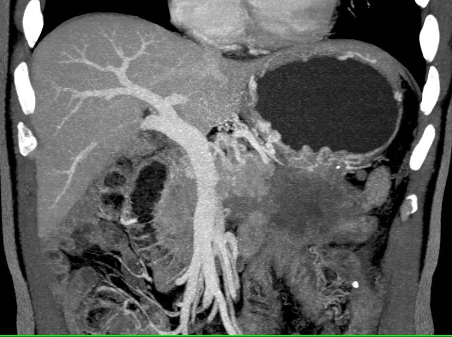 Adenocarcinoma of the Tail of the  Pancreas - CTisus CT Scan