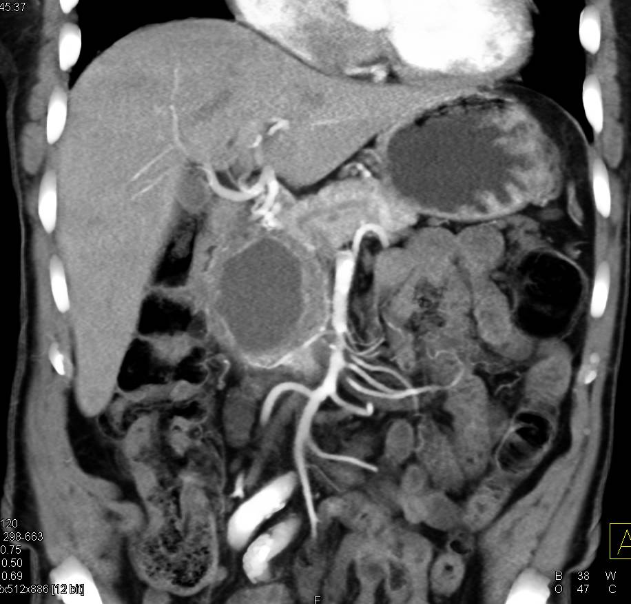 Necrotic Carcinoma of the Head of the Pancreas - CTisus CT Scan