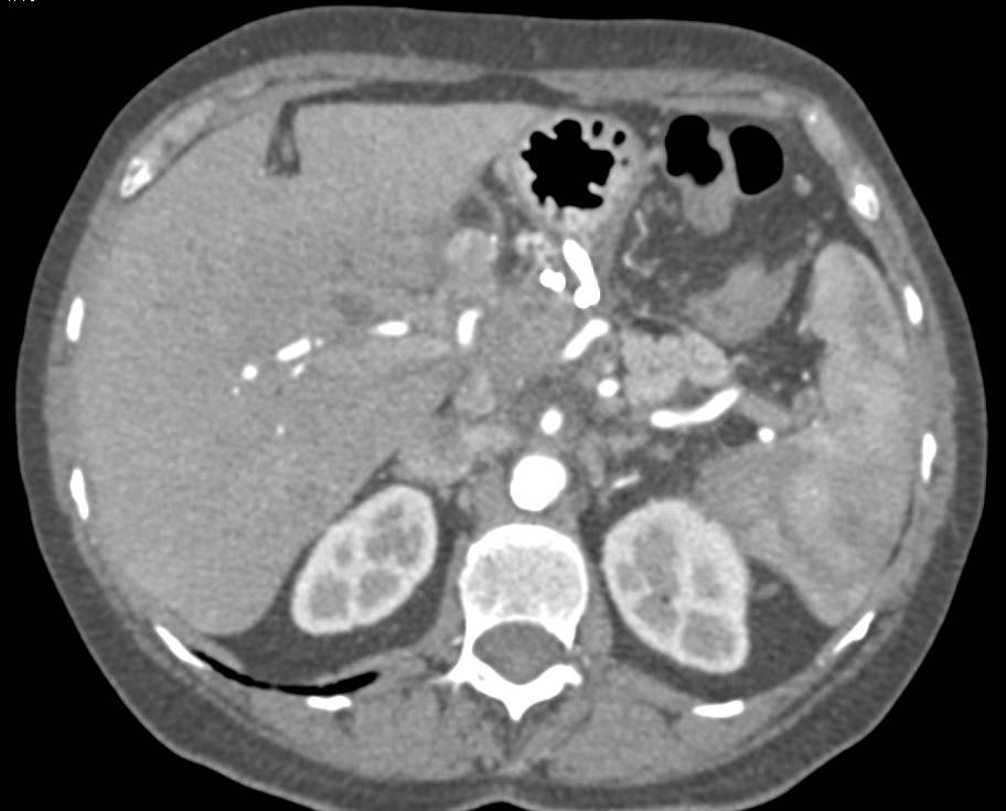 Pancreatitis with Cavernous Transformation of the Portal Vein (CTPV) and Portal Vein Occlusion and Pseudocyst with Drain Through Stomach (Cystogastrostomy) - CTisus CT Scan