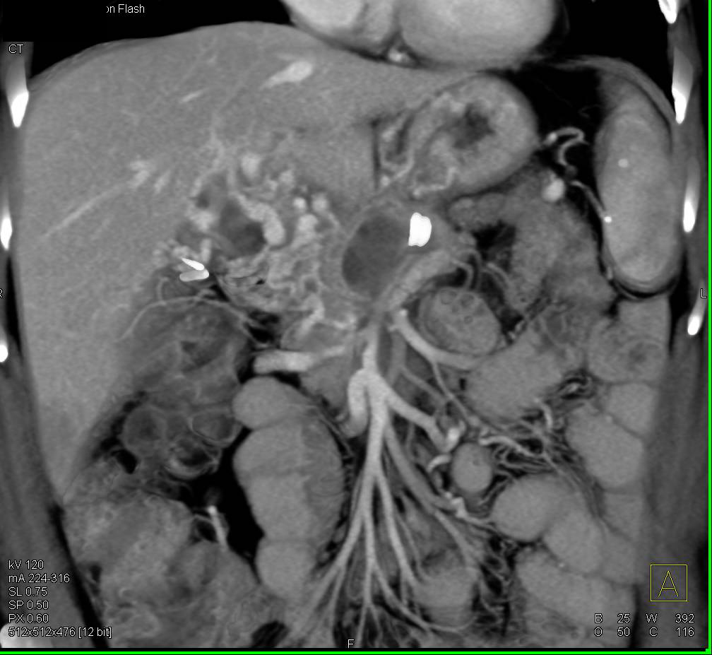 Pancreatic Cancer with Portal Vein Encasement and Cavernous Transformation of the Portal Vein (CTPV) - CTisus CT Scan