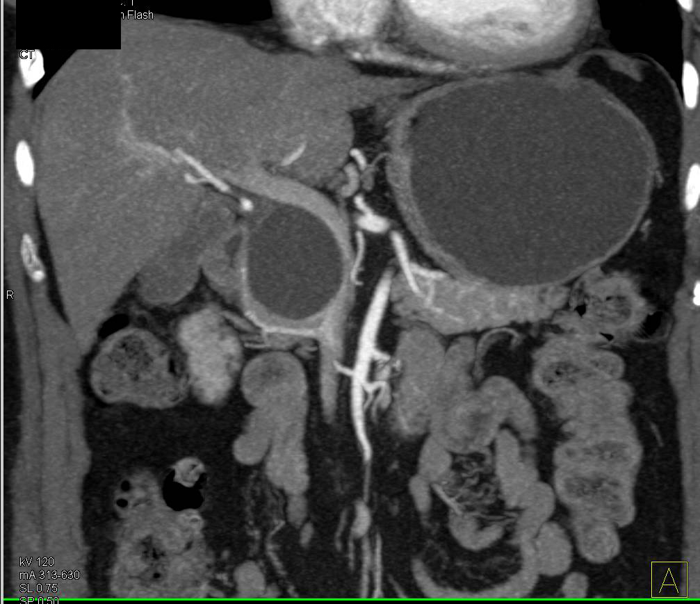 Serous Cystadenoma Looks Like an Intraductal Papillary Mucinous Neoplasm (IPMN) - CTisus CT Scan