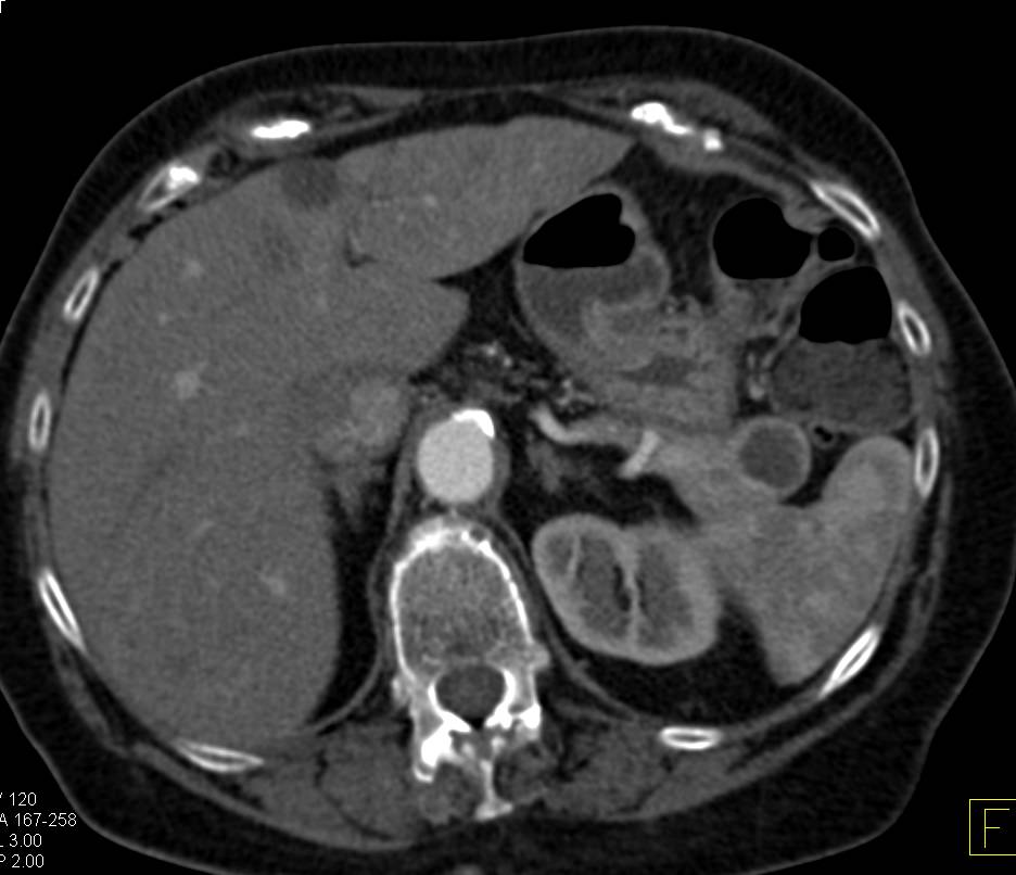 Cystic Neuroendocrine Tumor in the Tail of the Pancreas - CTisus CT Scan