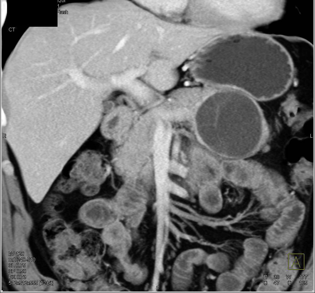 MCN (Mucinous Cystic Neoplasm) of the Pancreas - CTisus CT Scan