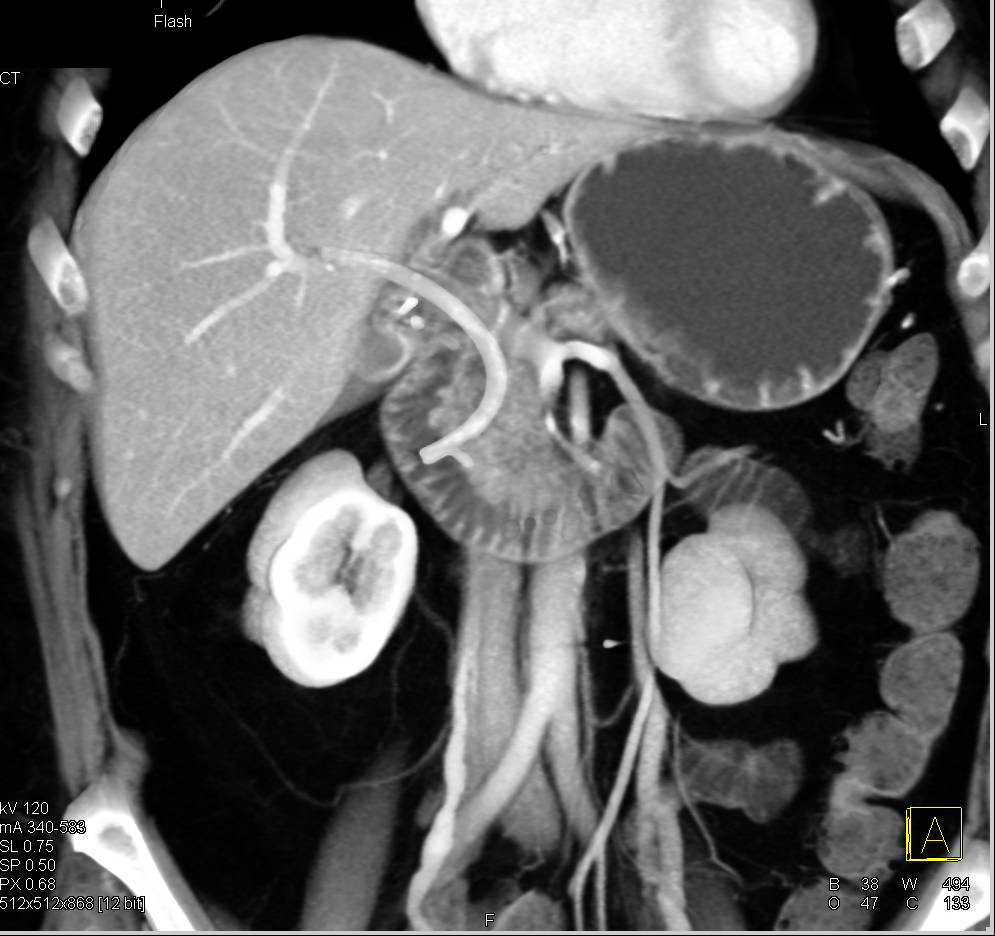 Ampullary Cancer with Common Bile Duct (CBD) Stent - CTisus CT Scan