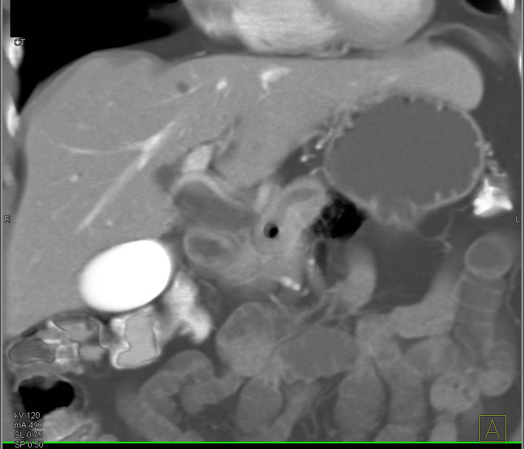 Pancreatic Cancer with Double Duct Sign Following Endoscopic Retrograde Cholangiopancreatography (ERCP) with Stenting - CTisus CT Scan