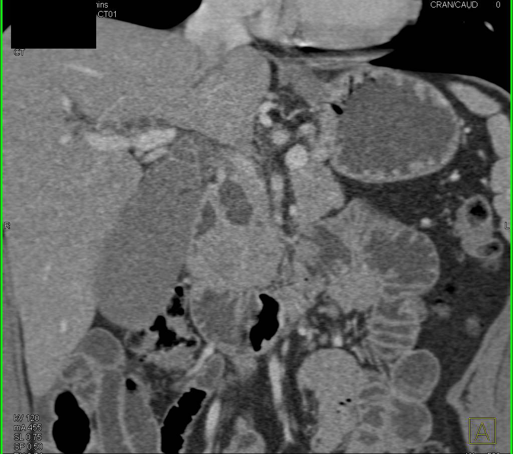 Ampullary Carcinoma with Dilated Common Bile Duct (CBD) - CTisus CT Scan