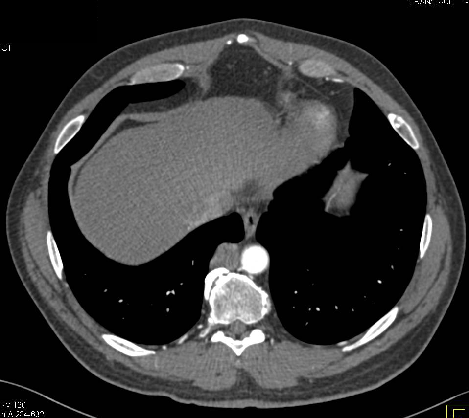 Neuroendocrine Tumor of the Pancreas with Vascular Invasion - CTisus CT Scan