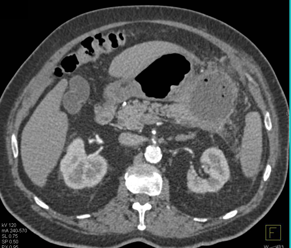 Pancreatic Abscess Extends to the Stomach - CTisus CT Scan