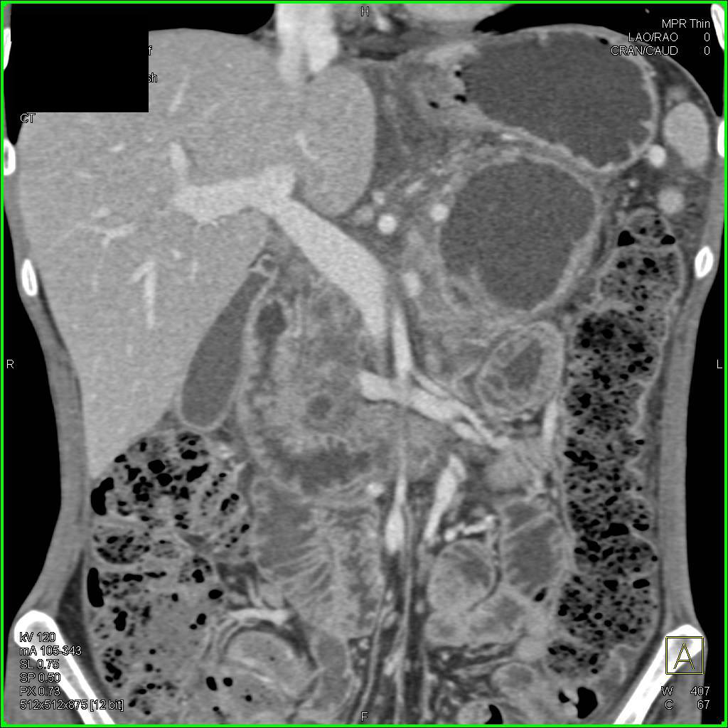 Complex Pancreatic Pseudocysts - CTisus CT Scan