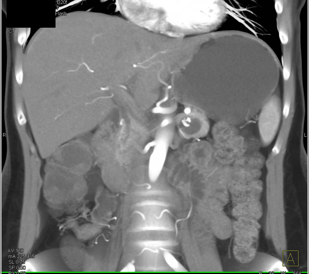 Intraductal Papillary Mucinous Neoplasm (IPMN) Tail of Pancreas with Calcification - CTisus CT Scan