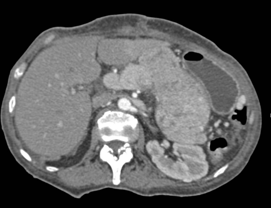 Neuroendocrine Tumor of the Pancreas Occludes the Splenic Vein with Collaterals - CTisus CT Scan