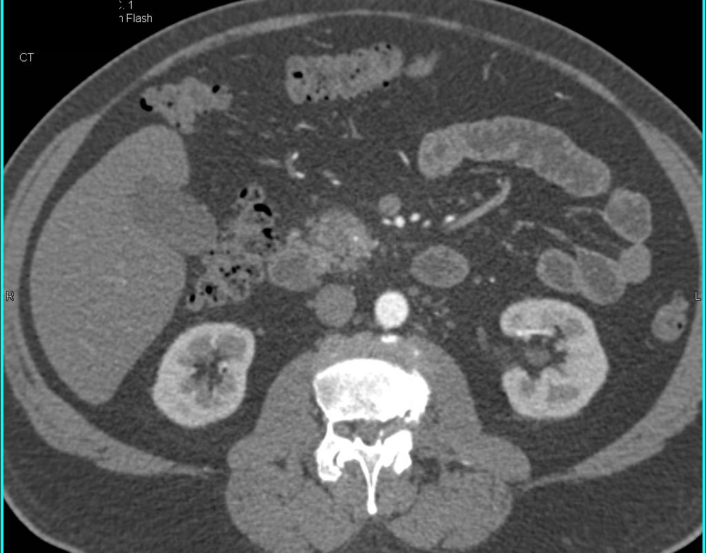 1 cm Neuroendocrine Tumor in the Head of the Pancreas - CTisus CT Scan