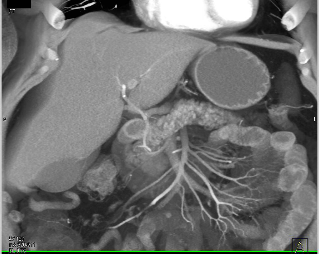 1cm Neuroendocrine Tumor in Head of Pancreas - CTisus CT Scan