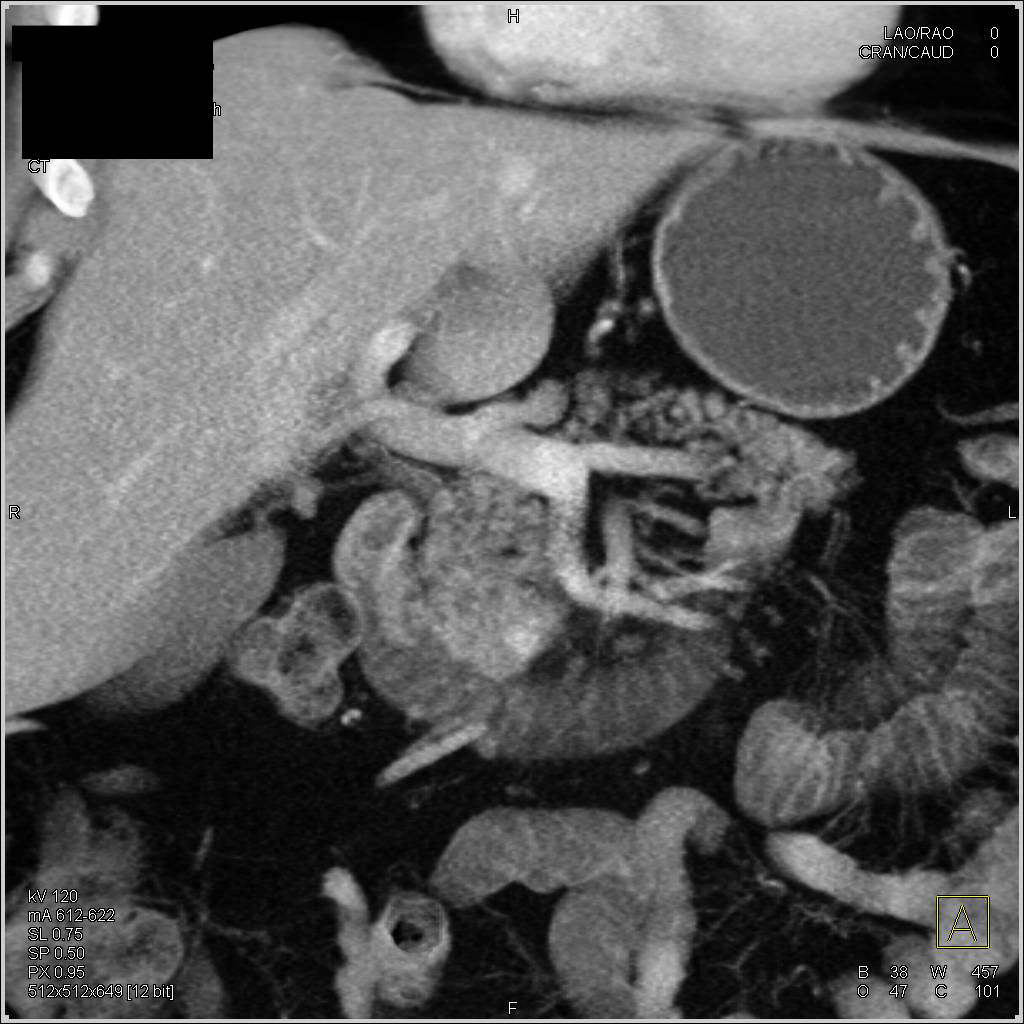 5 mm Neuroendocrine Tumor in Head of Pancreas - CTisus CT Scan