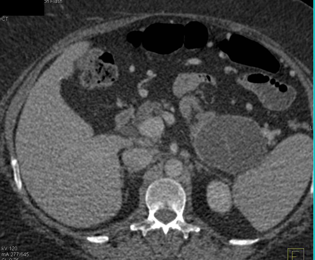 Mucinous Cystsic Tumor (MCN) in Tail of Pancreas - CTisus CT Scan