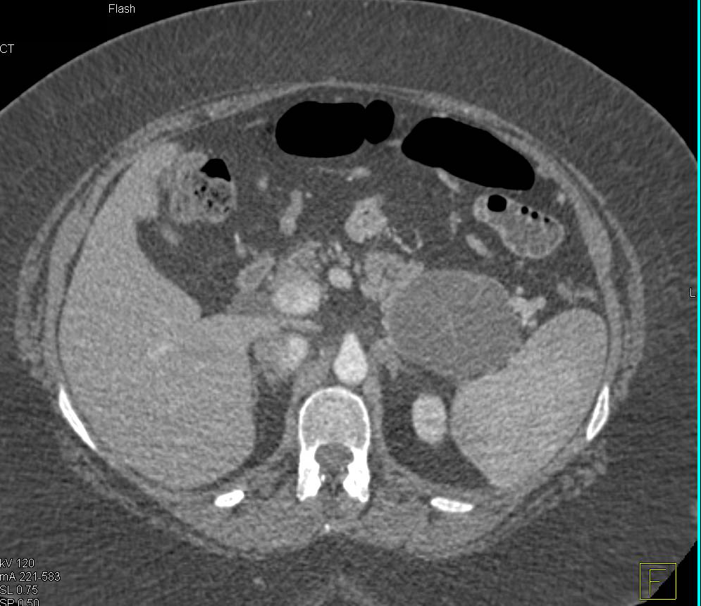 Pancreatic Cystic lesion was a MCN (Mucinous Cystic Neoplasm) - CTisus CT Scan