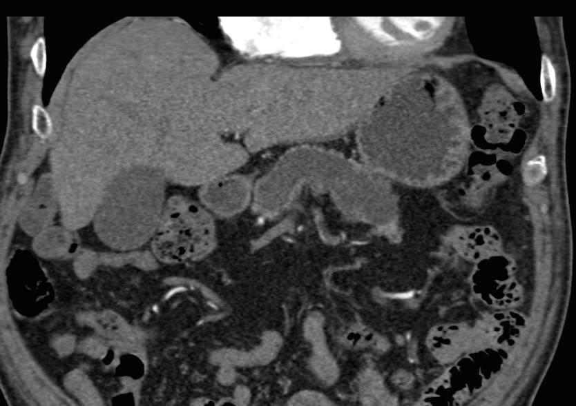 Central Intraductal Papillary Mucinous Neoplasm (IPMN) with Markedly Dilated Pancreatic Duct - CTisus CT Scan