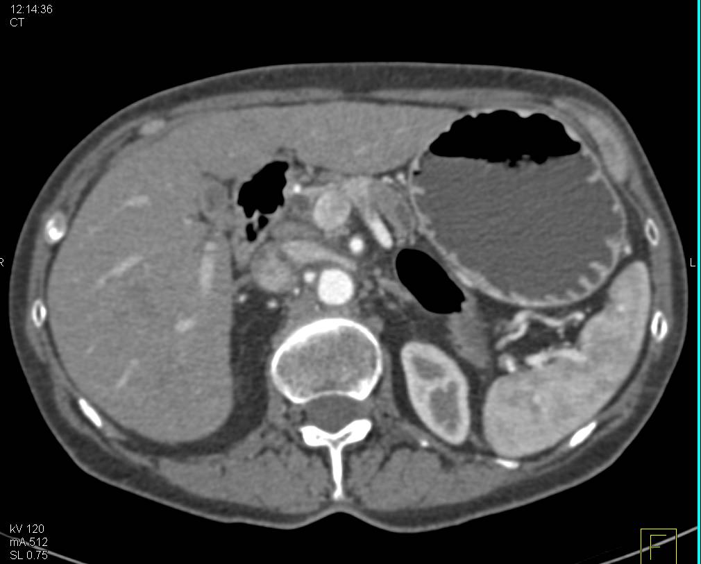 Subtle Pancreatic Adenocarcinoma Obstructs the Pancreatic Duct - CTisus CT Scan