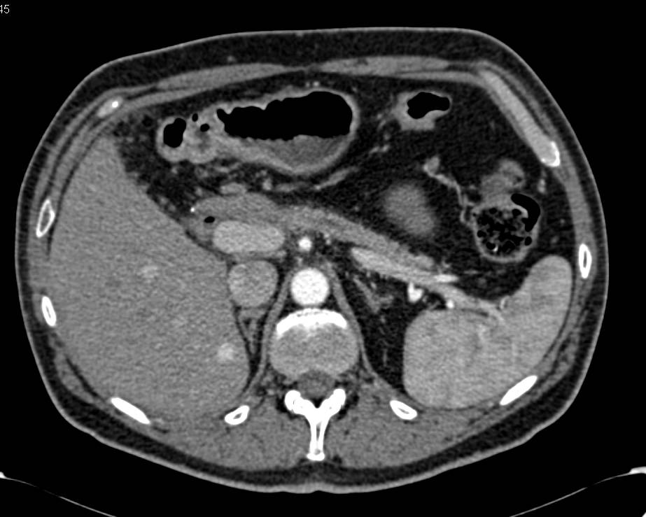 Carcinoma of the Head of the Pancreas - CTisus CT Scan