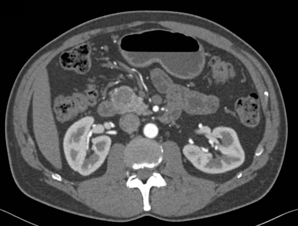 Atypical Serous Cystadenoma in the Head of the Pancreas - CTisus CT Scan