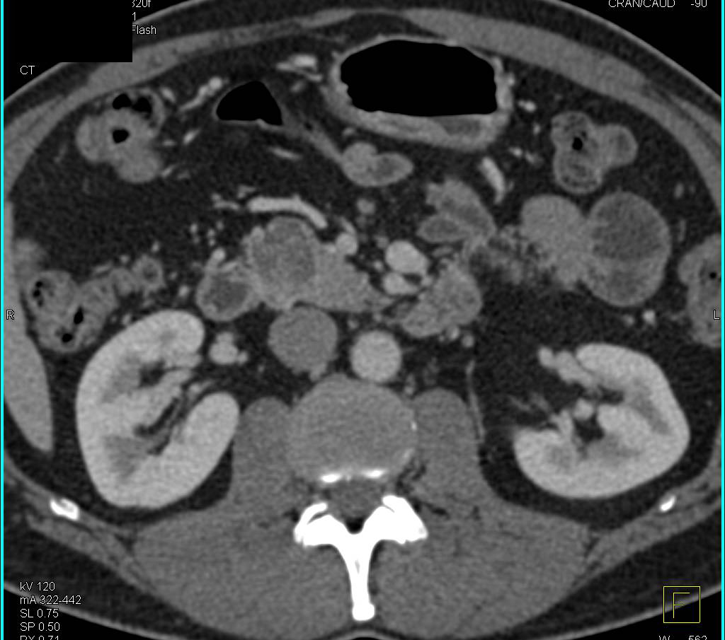 Cystic Islet Cell Tumor of the Pancreas - CTisus CT Scan