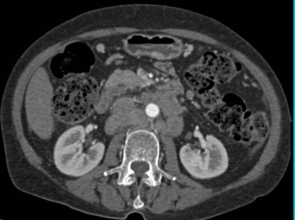 Unusual Case of Pancreatic Cancer with Bulky Nodes and Splenic Lesions - CTisus CT Scan