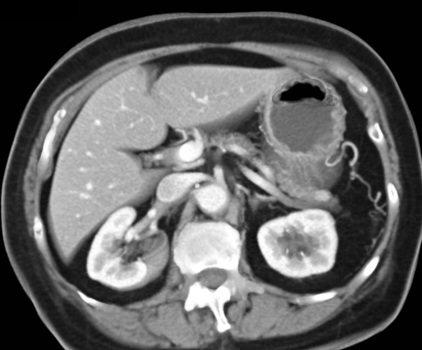 Subtle 1cm Neuroendocrine Tumor in Tail of Pancreas - CTisus CT Scan