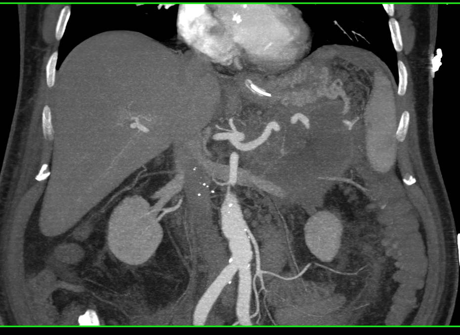 Pancreatic Necrosis - CTisus CT Scan