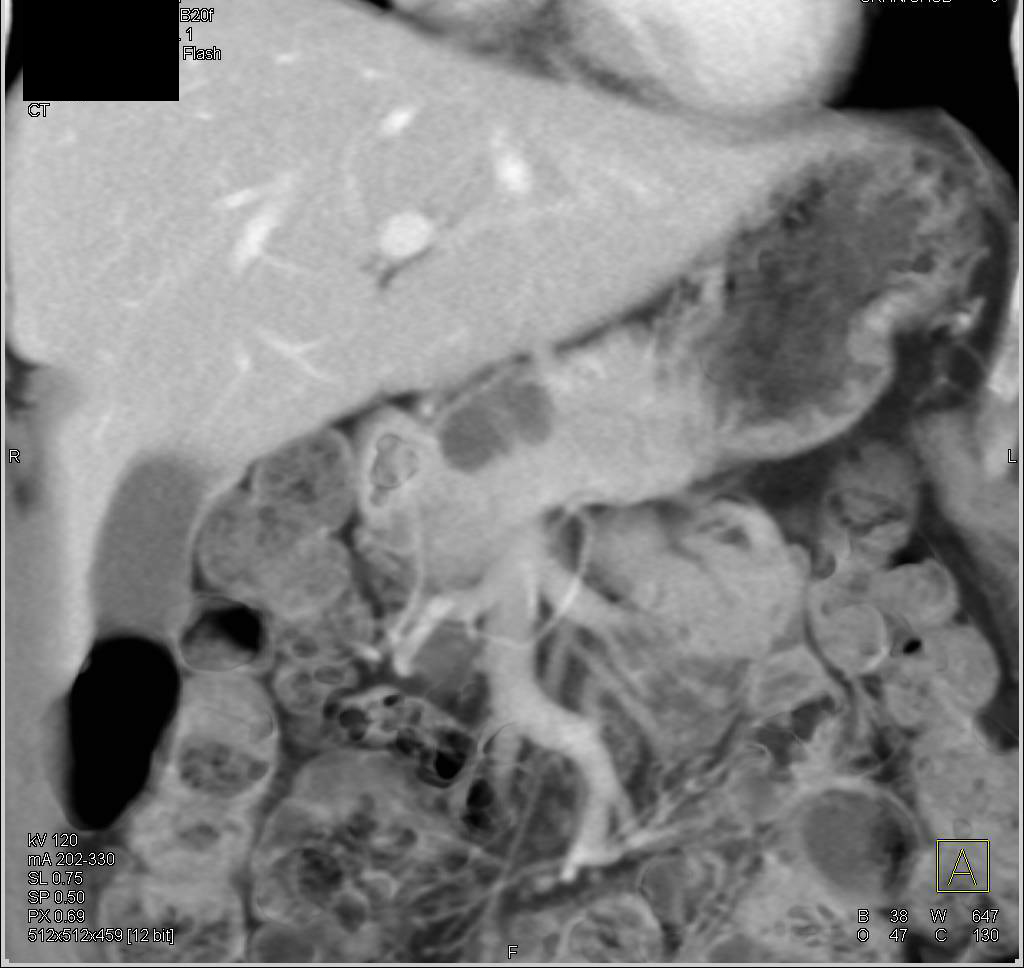 Serous Cystadenoma - CTisus CT Scan