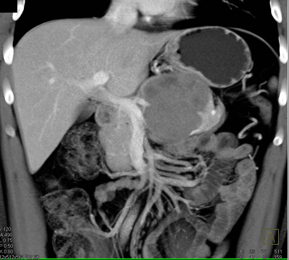 Neuroendocrine Tumor - CTisus CT Scan