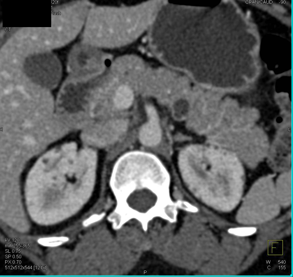 Intraductal Papillary Mucinous Neoplasm (IPMN) with Septation - CTisus CT Scan