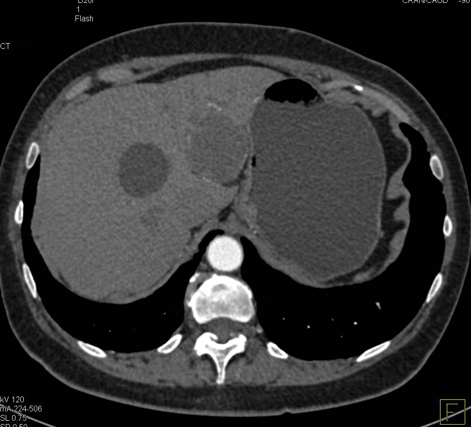 Serous Cystadenoma of the Pancreas - CTisus CT Scan