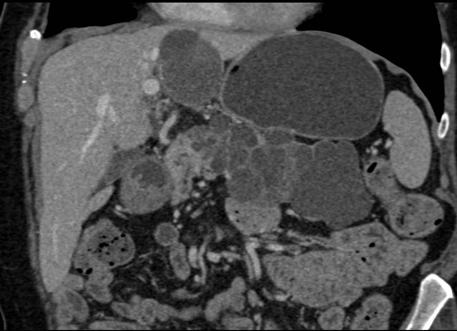 Serous Cystadenoma and Hepatic Cysts - CTisus CT Scan