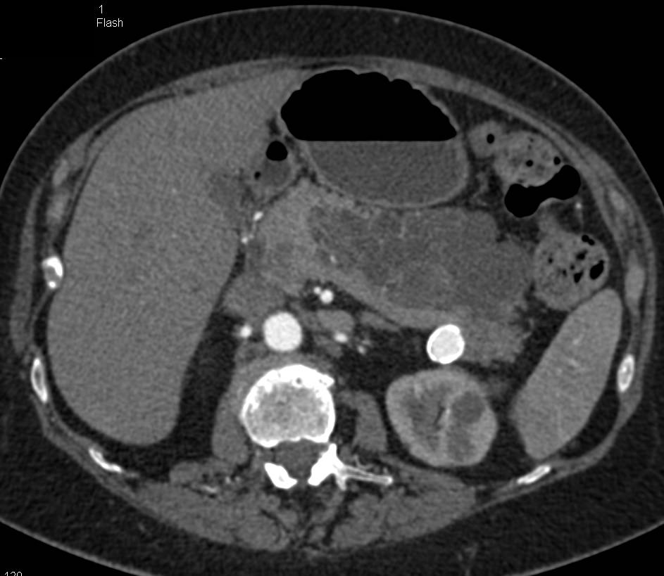 Serous Cystadenoma with Central Calcification - CTisus CT Scan