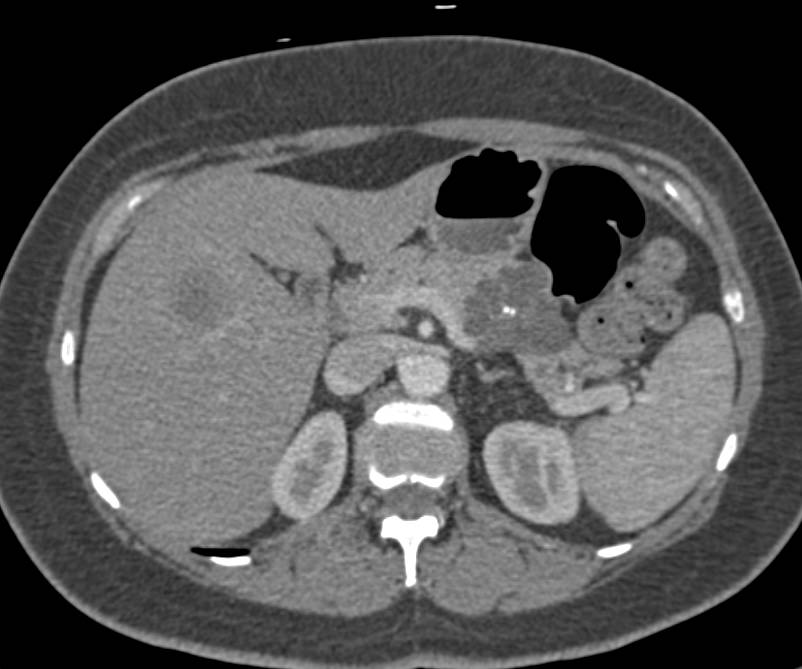 Pancreatic Serous Cystadenoma with Central Calcification - CTisus CT Scan