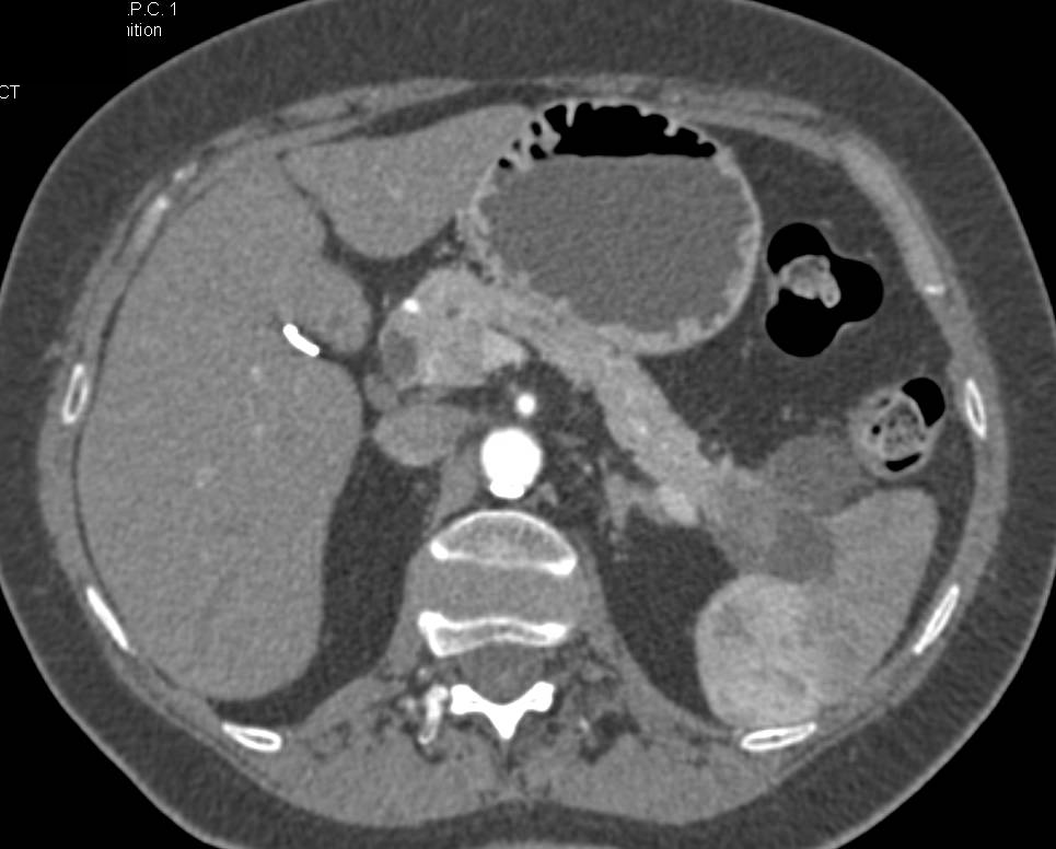 Adenocarcinoma of the Tail of the Pancreas - CTisus CT Scan