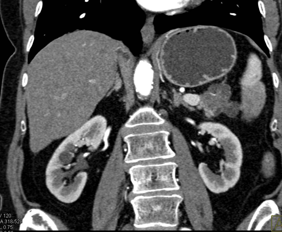 Carcinoma of the Tail of the Pancreas Invades the Spleen - CTisus CT Scan