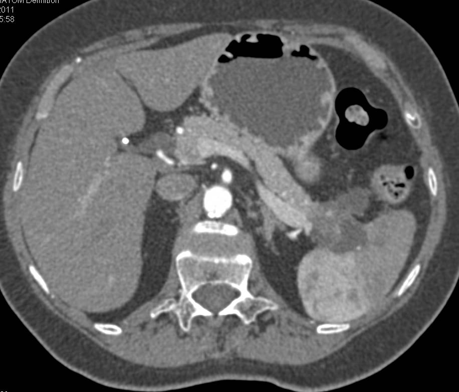 Cystic Adenocarcinoma of the Tail of the Pancreas - CTisus CT Scan