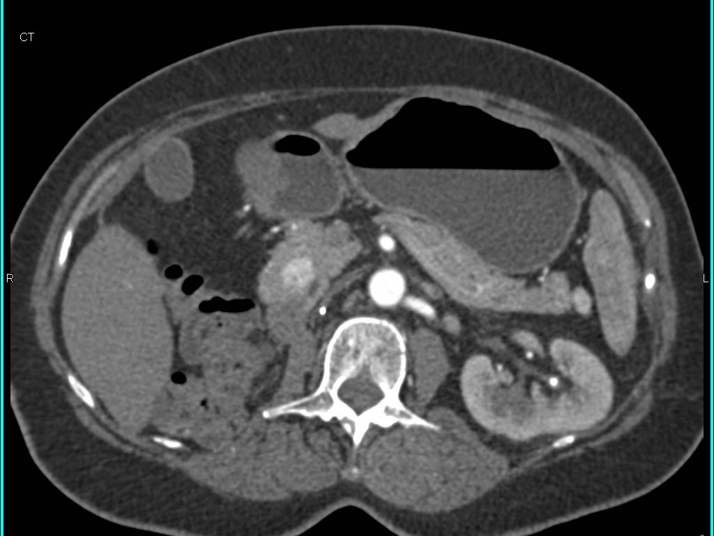 Metastatic Renal Cell Carcinoma to the Pancreas with Vascular Metastases - CTisus CT Scan