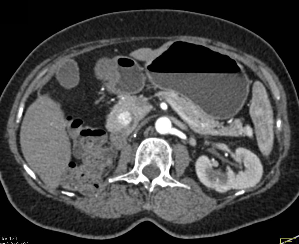 Metastatic Renal Cell Carcinoma to the Head of the Pancreas - CTisus CT Scan