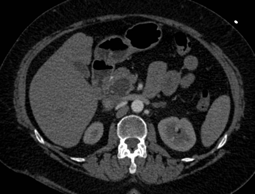 Serous Cystadenoma Looks Like an Intraductal Papillary Mucinous Neoplasm (IPMN) - CTisus CT Scan