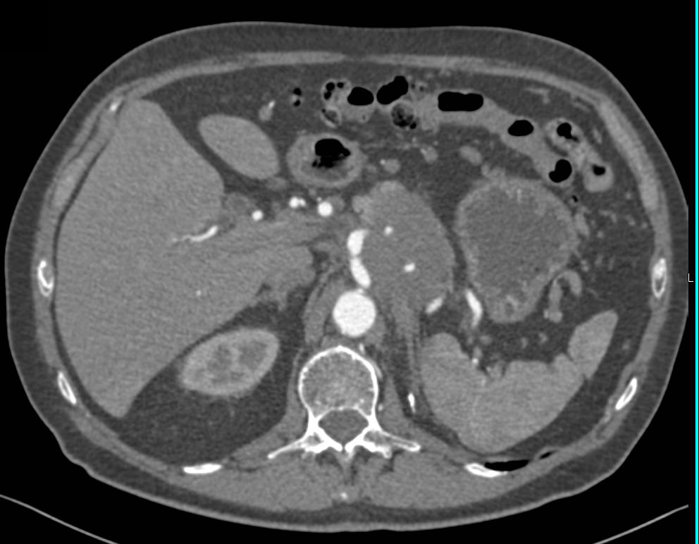 Pancreatic Cancer with Encased Celiac and SMA - CTisus CT Scan