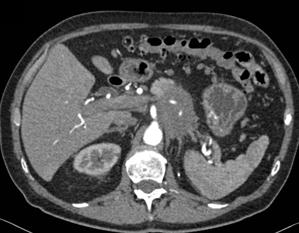 Pancreatic Cancer with Arterial and Venous Involvement - CTisus CT Scan