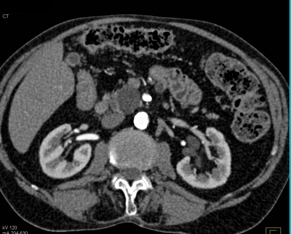 Intraductal Papillary Mucinous Neoplasm (IPMN) of the Pancreas - CTisus CT Scan