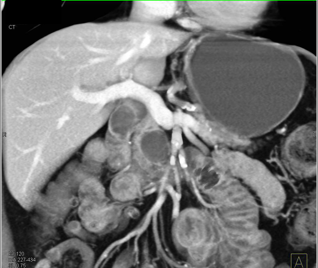 Intraductal Papillary Mucinous Neoplasm (IPMN) in the Pancreatic Head - CTisus CT Scan